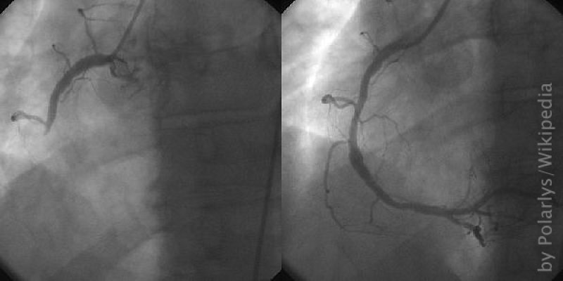 Coronary catheterization- a minimally invasive procedure to access the coronary circulation and blood filled chambers of the heart using a catheter
(c) Polarlys, Wikipedia