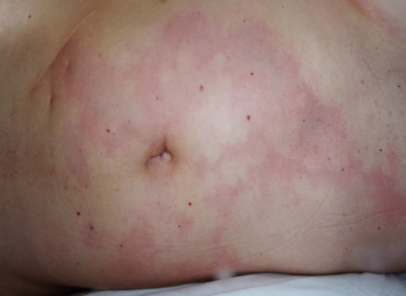 Cutis Marmorata
(c) Kirsten A.