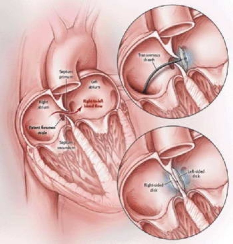 Graphic: closing a PFO
