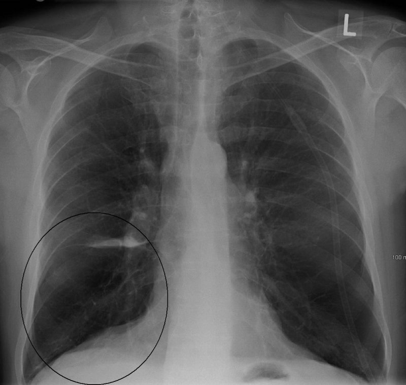 Lung bulla as seen on CXR in a person with severe COPD associated with anti 1 antitrypsin deficiency.
(c) James Heilman, MD