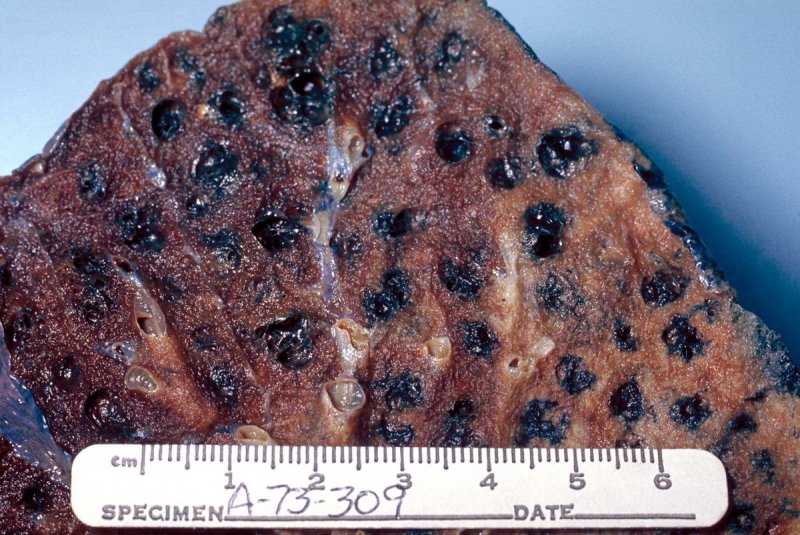 Gross pathology of the lung showing centrilobular emphysema characteristic of smoking. Closeup of fixed, cut surface shows multiple cavities lined by heavy black carbon deposits.
(c) Dr. Edwin P. Ewing, Jr.