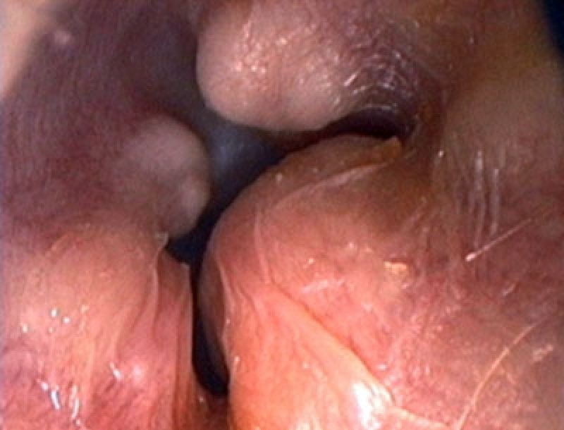 Swimmers Ear/Surfers Ear: Narrowing of the ear canal (Exostosis)
(c) Archive Taucher.Net