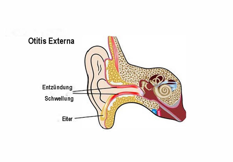 Inflammation of the ear canal
(c) Changed according to Ekaterina Murasheva: Types of Otitis