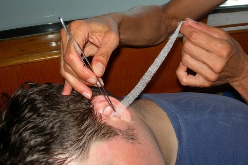 Otitis treatment
(c) Archive Taucher.Net